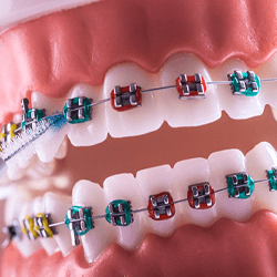 Braces on dental model, being cleaned by interdental brush