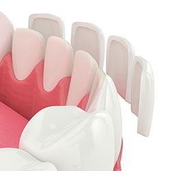 Animated smile during porcelain veneer placement