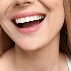 Close-up of woman’s beautiful smile with veneers in Wellesley