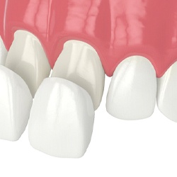 Illustration of veneers in Wellesley being placed on front teeth