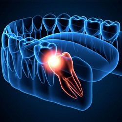 Illustration of impacted wisdom tooth pushing against other teeth