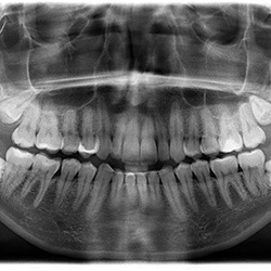 Dental X-ray showing four wisdom teeth