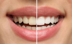 Close-up of woman&rsquo;s smile before and after teeth whitening 